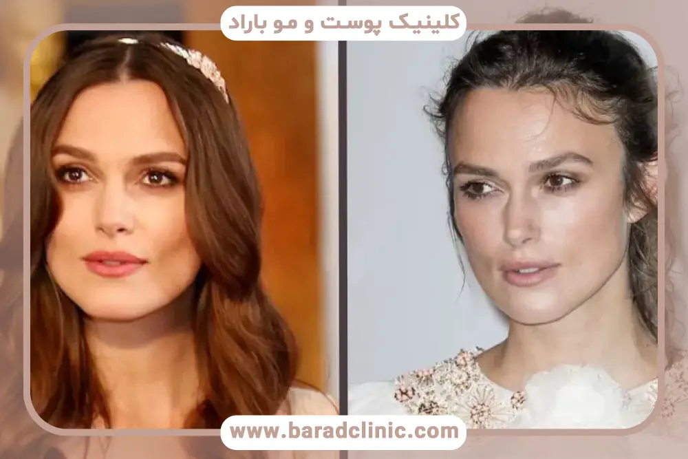 دلایل محبوبیت کاشت مو افراد مشهور