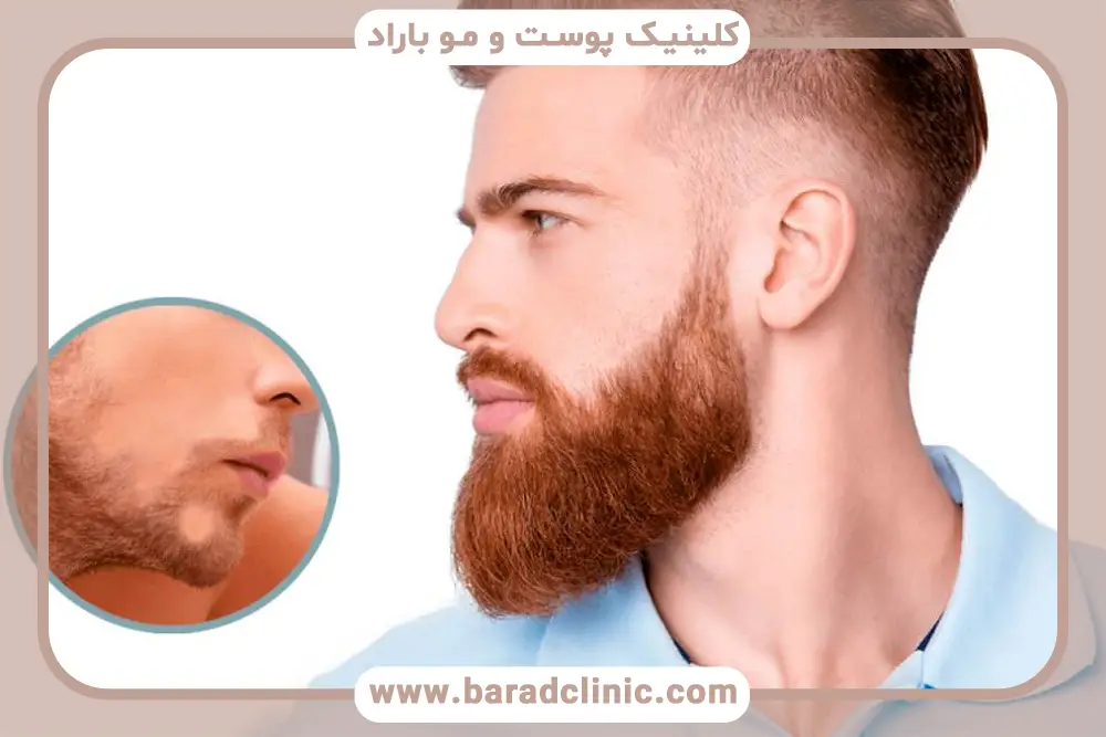 مزایای کاشت ریش با نیدل 