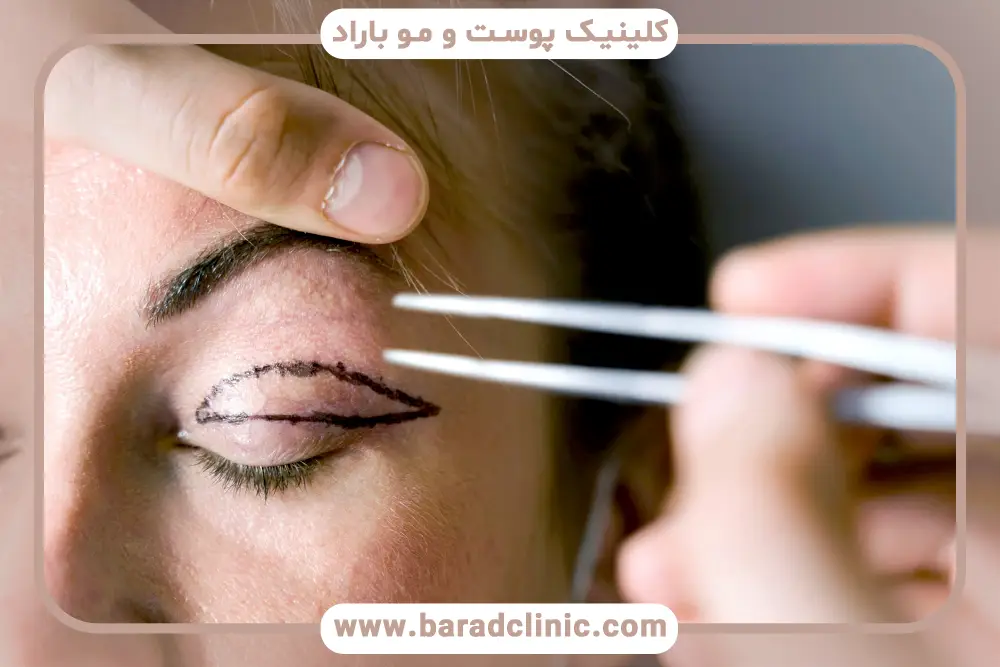 انواع جراحی زیبایی چشم