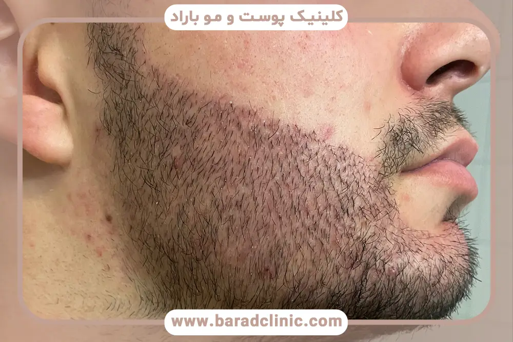 دلایل کاشت ریش ناموفق