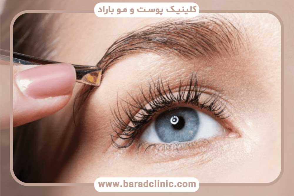 کاشت ابرو با تراکم بالا