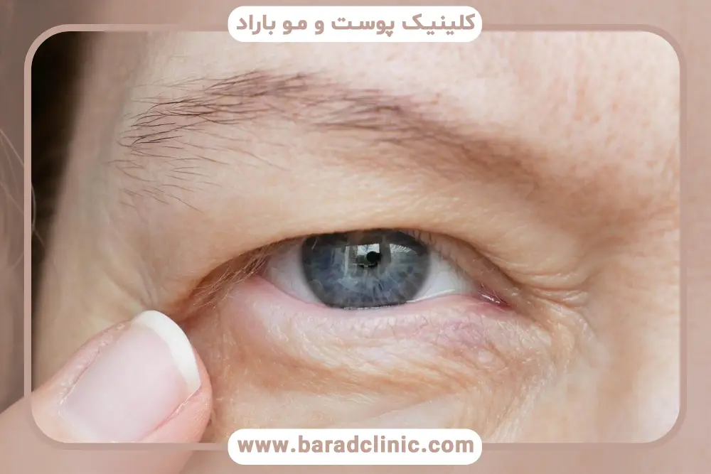 بلفاروپلاستی توسط چشم پزشک یا جراح پلاستیک؟