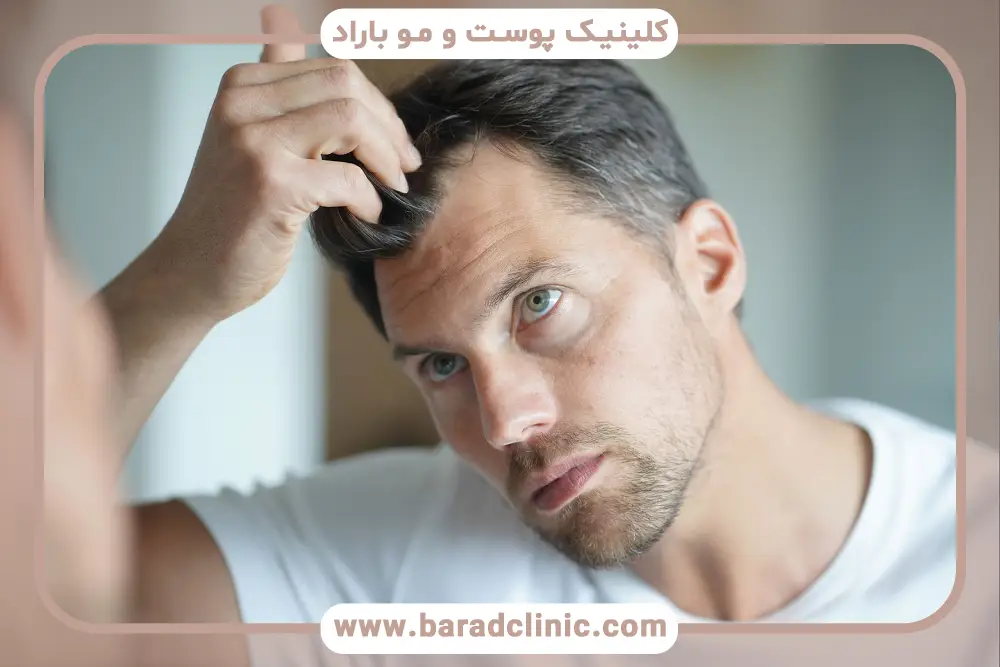 علائم ریزش موی ناشی از تستوسترون