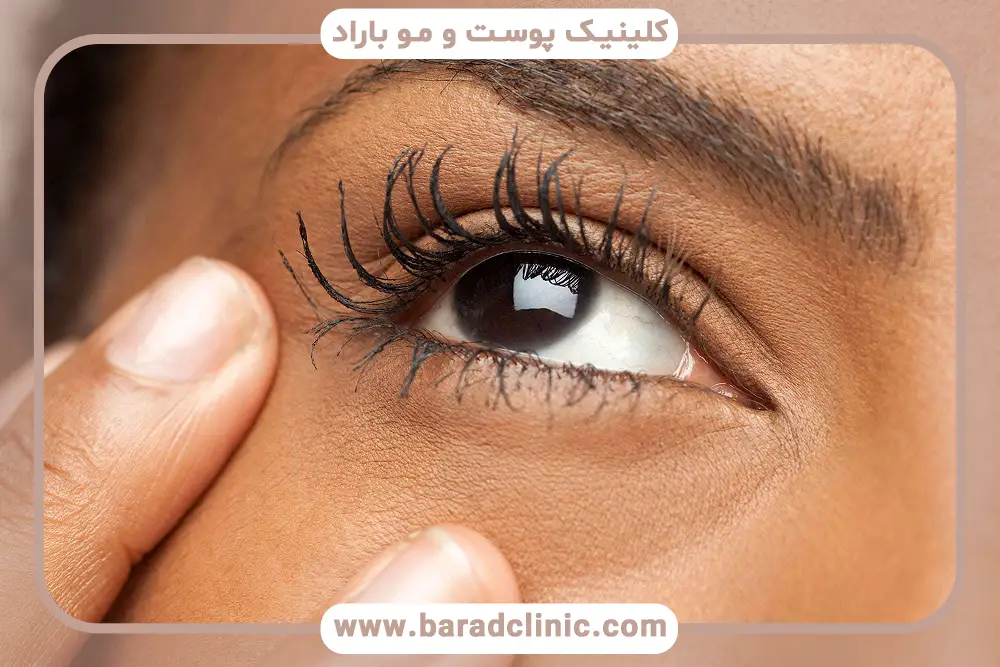 بهترین زمان برداشتن چسب بلفاروپلاستی 