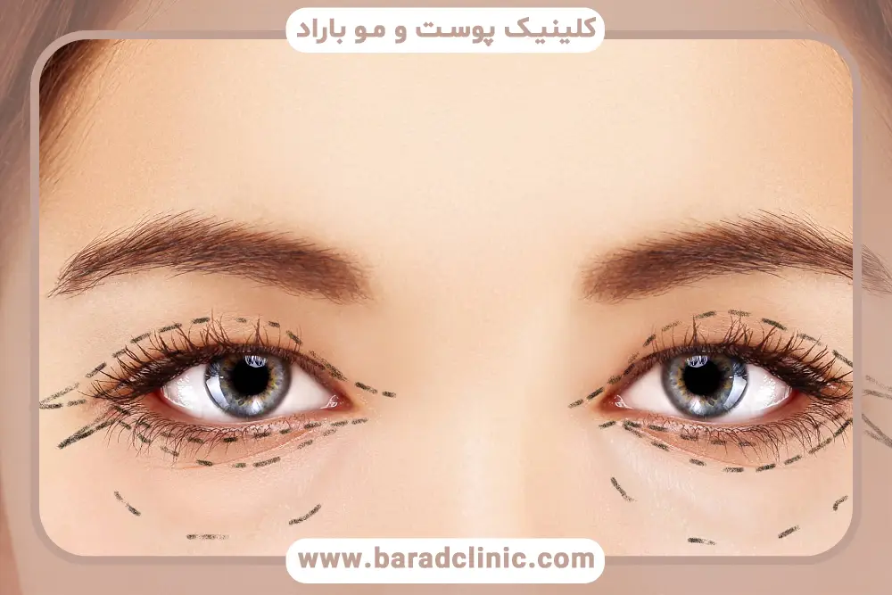 ظاهر پلک‌ها یک ماه بعد از عمل بلفاروپلاستی