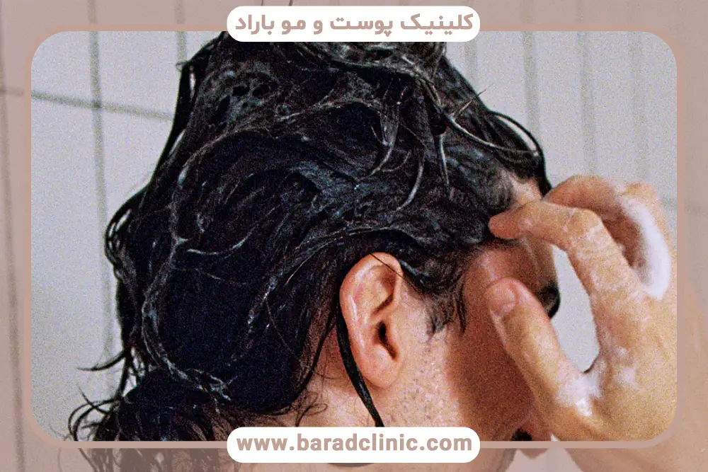 دلایل انتخاب بهترین شامپو بعد از کاشت مو