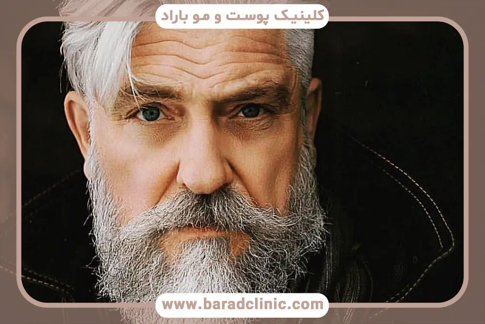 مزایای کاشت ریش سفید