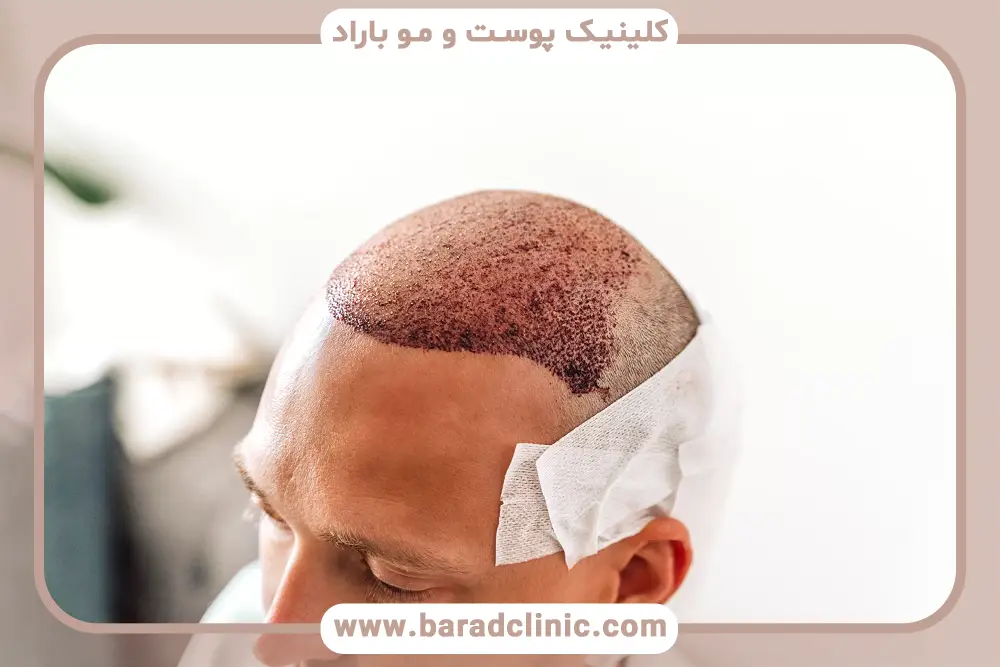 تاثیر نور آفتاب بعد از کاشت مو روی گرافت‌های جدید