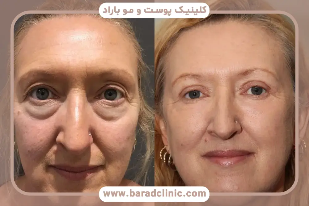 دلایل انجام بلفاروپلاستی چهار پلک