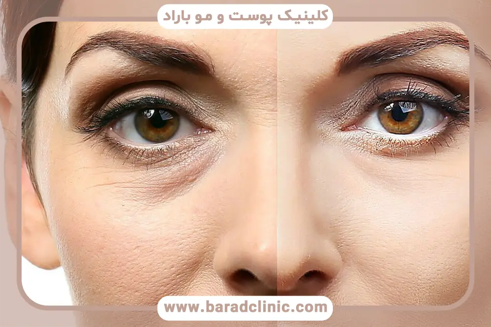 آشنایی با بلفاروپلاستی با لیزر co2