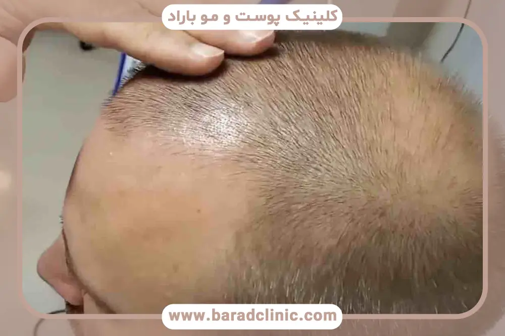 فرایند کاشت مو با جدیدترین روش کاشت مو بدون بانک مو