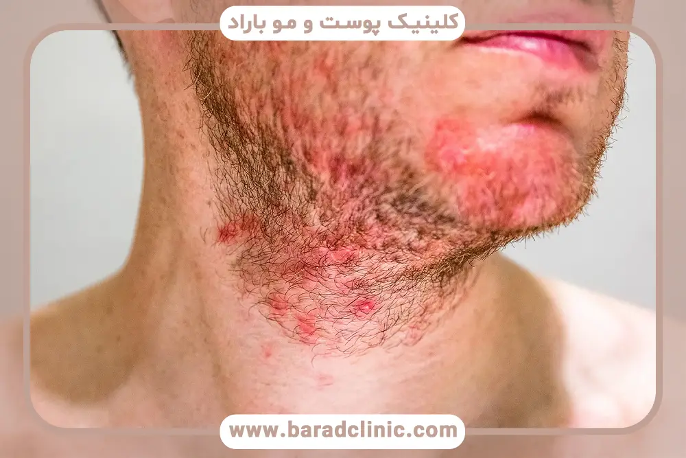 دلایل خارش بعد از کاشت ریش