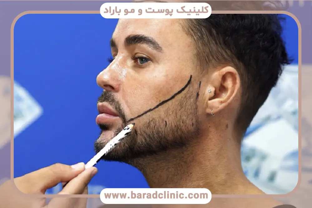 تفاوت کاشت ریش وی ای پی با کاشت ریش معمولی