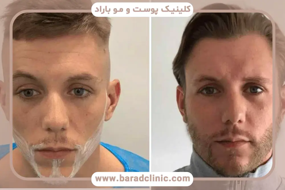 کاربردهای کاشت ریش موضعی