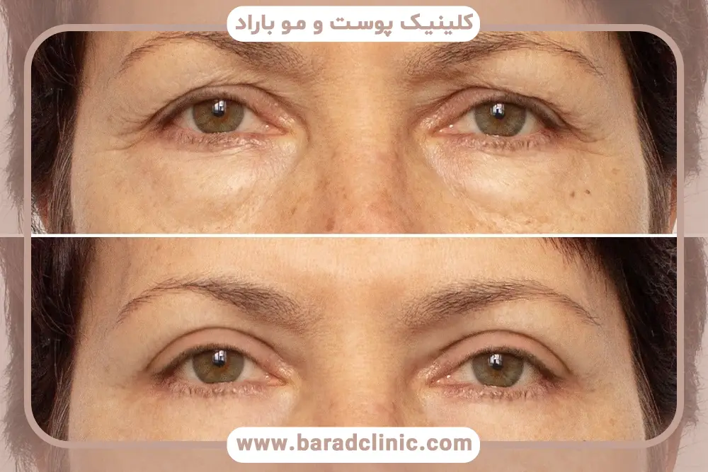 کدام روش بلفاروپلاستی چشم رو لیفت میکنه؟ بررسی روشها