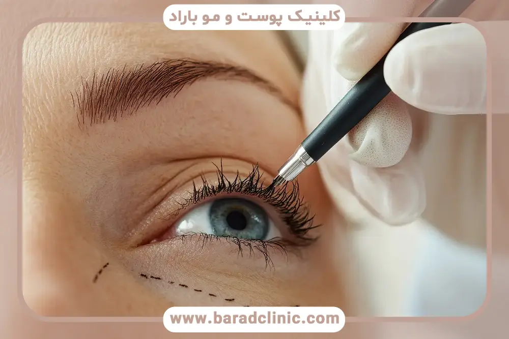 دلایل نیاز به بلفاروپلاستی ترمیمی 