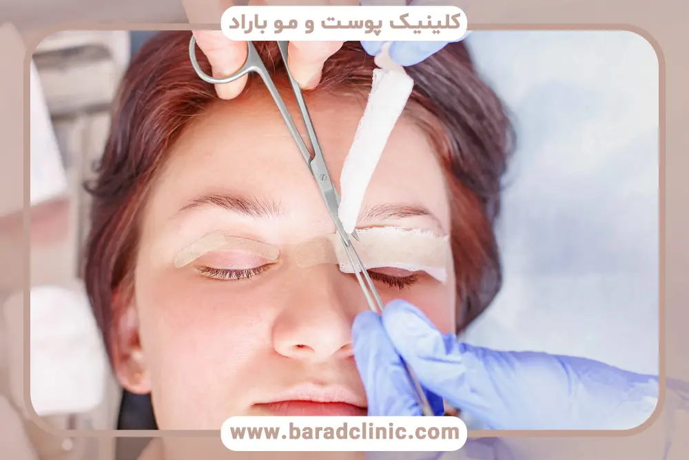 تفاوت بلفاروپلاستی ترانس کونژ با روشهای سنتی