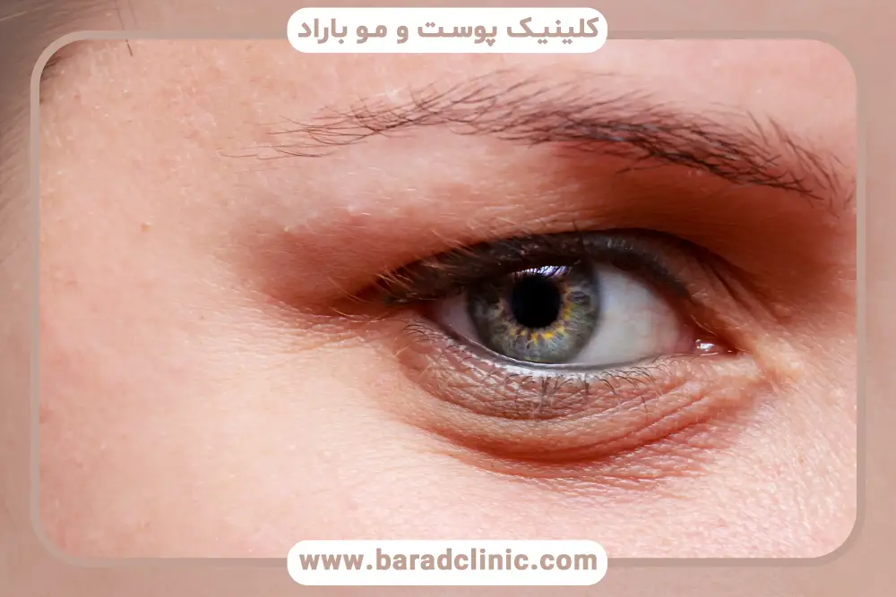 شرایط کلی بلفاروپلاستی اقساطی