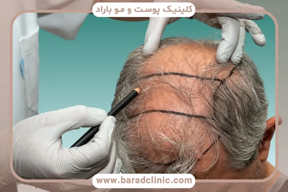 ویژگیهای کاشت مو به روش dhi