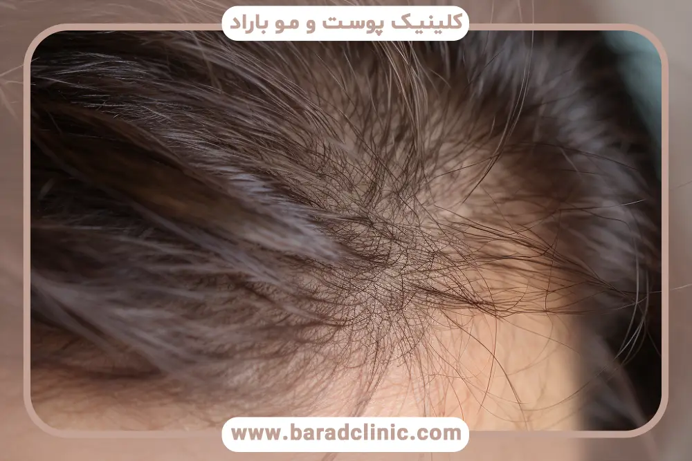 اهمیت بررسی فیلم ترمیم مو به روش مایکروپوینت 