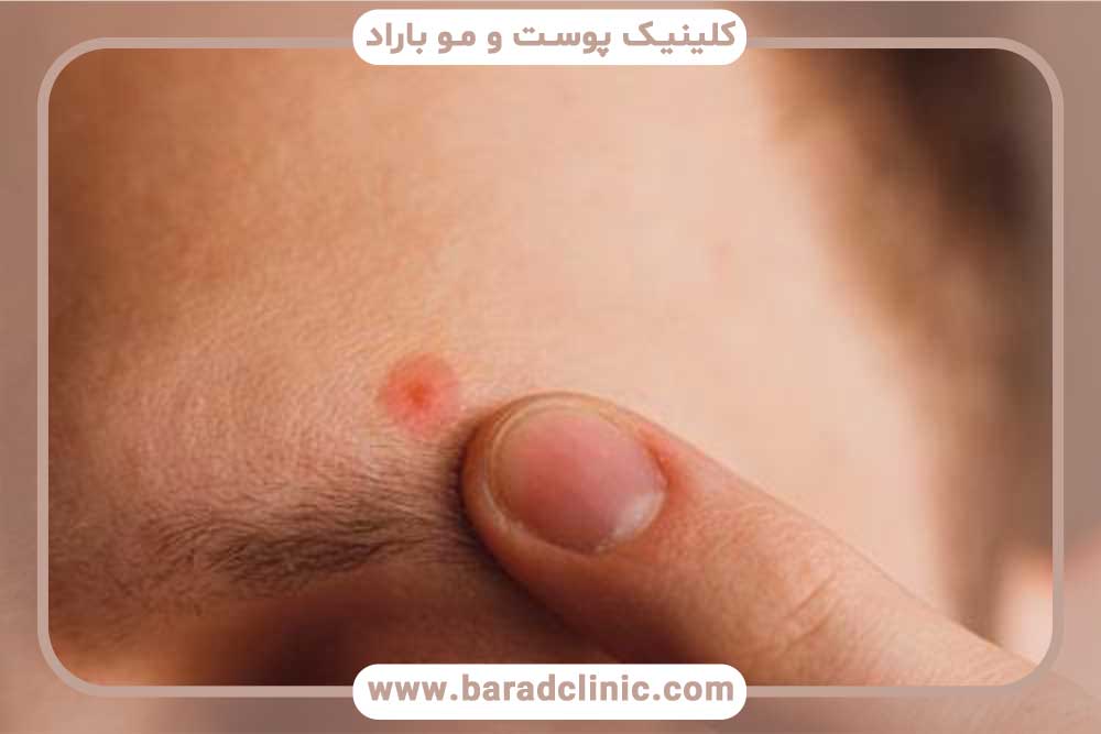 جوش بعد از کاشت ابرو