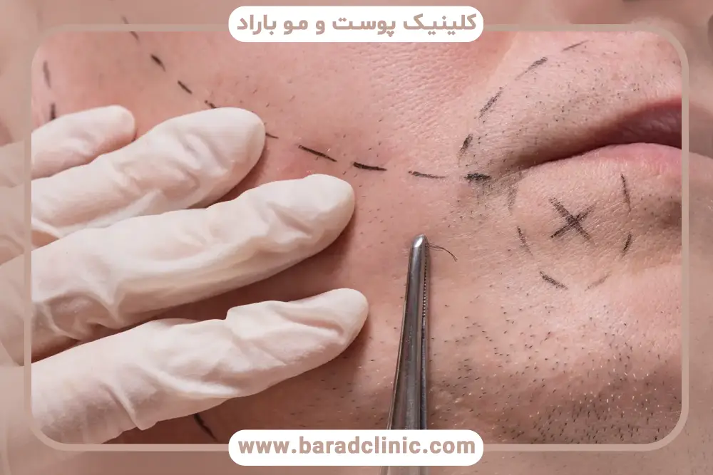 ویژگی‌های جدیدترین روش کاشت ریش