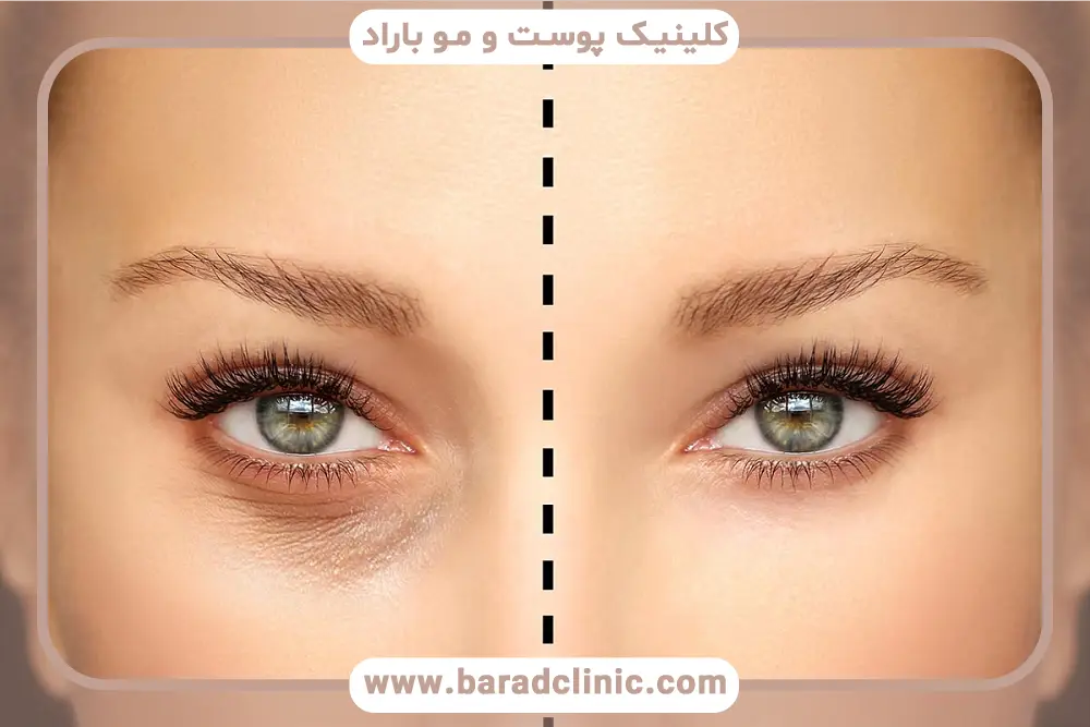 انواع بلفاروپلاستی چشم 