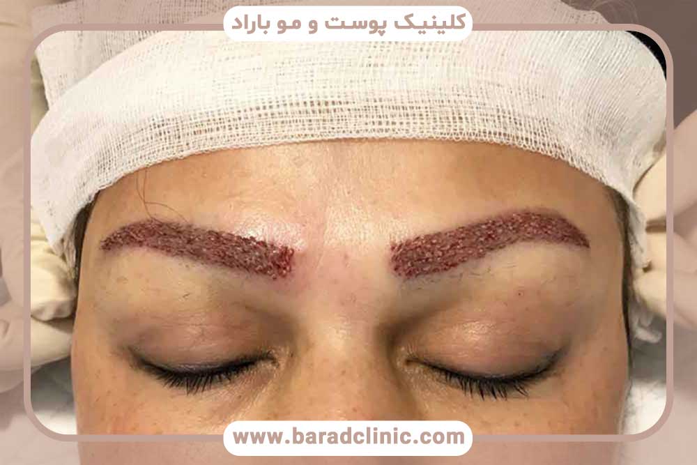 خطرات کاشت ابرو