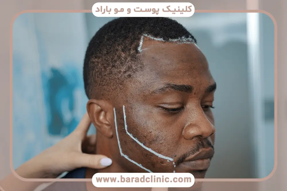 مراحل کاشت ریش مردان