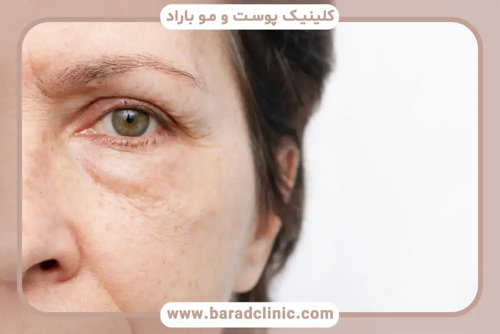 مراحل بلفاروپلاستی پف زیر چشم 