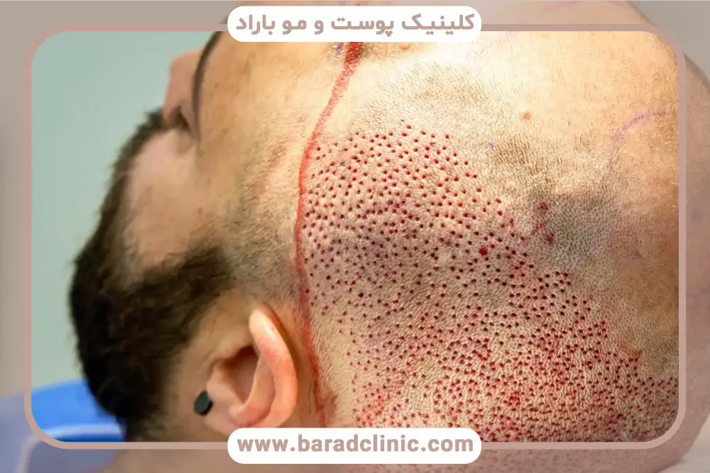 بهترین حالت خواب در نحوه خواب بعد از کاشت مو 