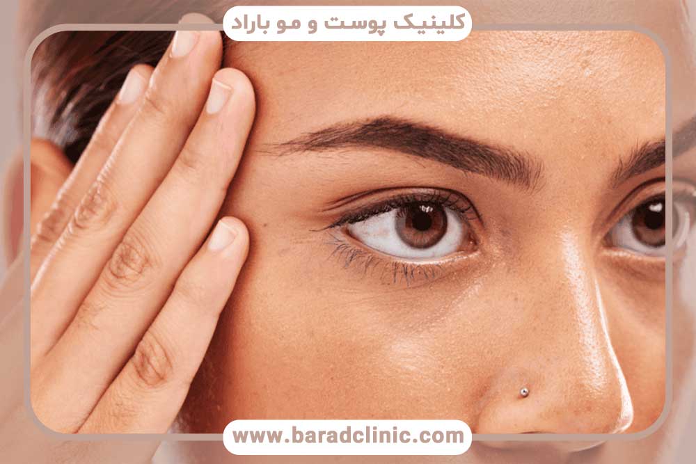 کاشت ابرو لیزری