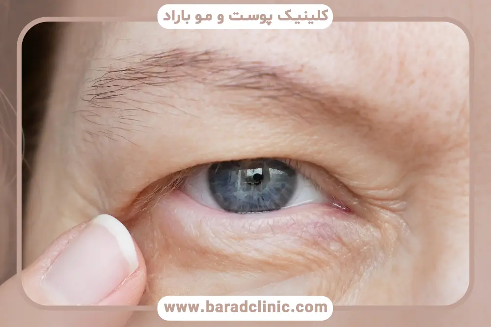 مراقبت‌های قبل از بلفاروپلاستی پلک بالا 