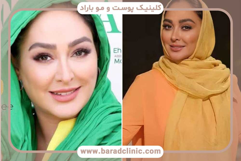 کاشت ابرو بازیگران