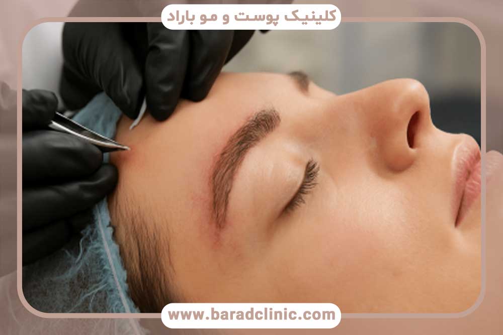 کاشت ابرو قسطی در تهران