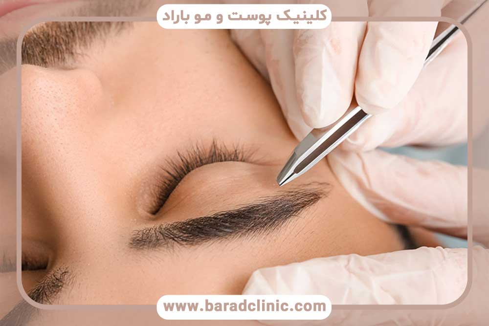 بهترین کاشت ابرو تهران