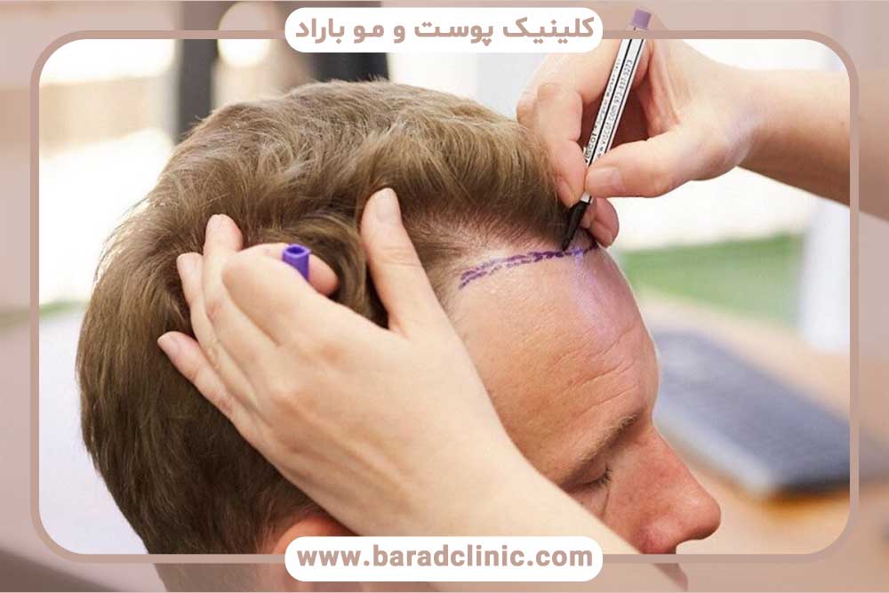 بهترین مرکز کاشت مو در تهران