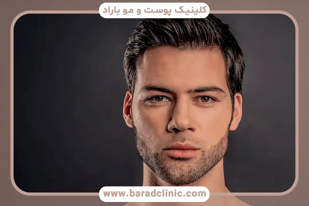 مراقبتهای قبل از کاشت ریش کم پشت