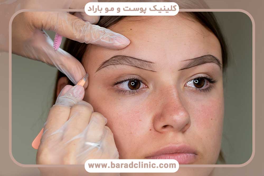 کاشت ابرو و پسوریازیس