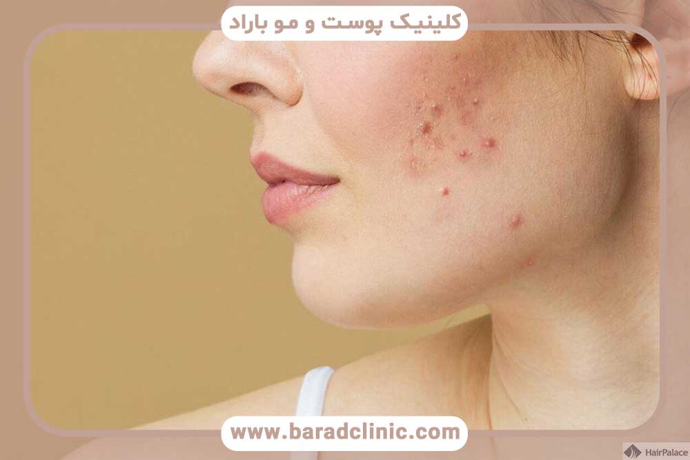 راکوتان و کاشت ابرو