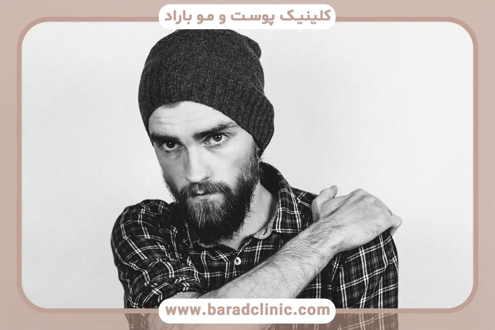 بررسی علمی کاشت ریش موقت 