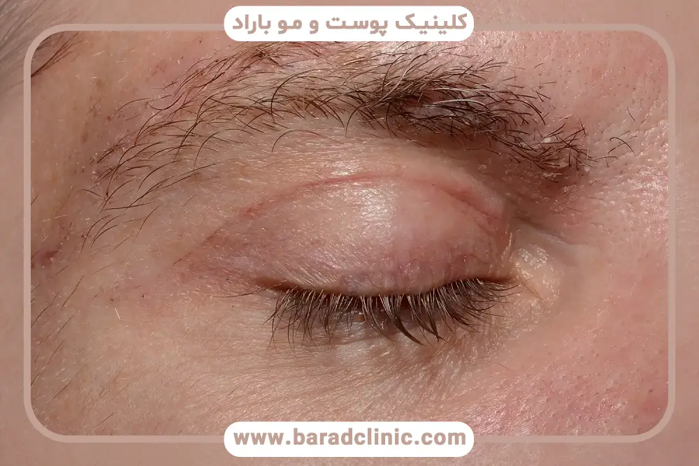 پیشگیری از ایجاد گوشت اضافه بعد از بلفاروپلاستی 