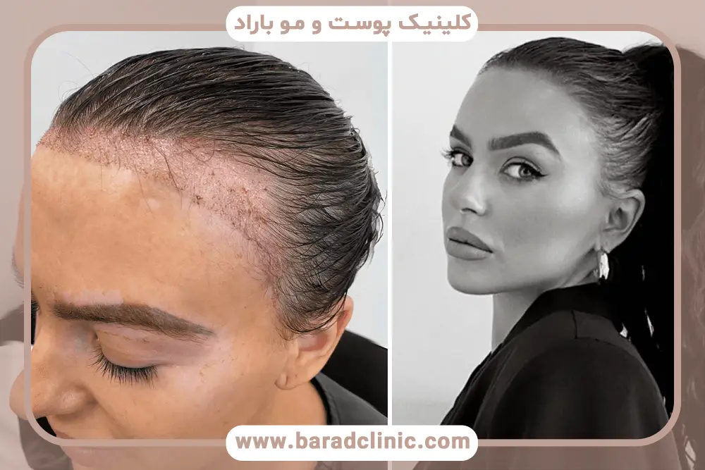 مراحل کاشت مو افراد مشهور