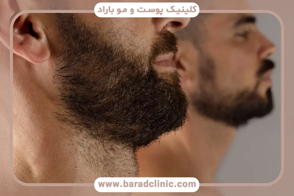 هزینه کاشت ریش با نیدل 