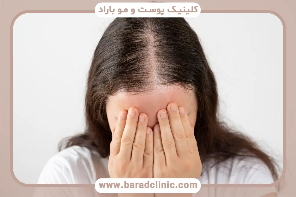 جلوگیری از ریزش مو در تنبلی تخمدان با مدیریت هورمون‌ها