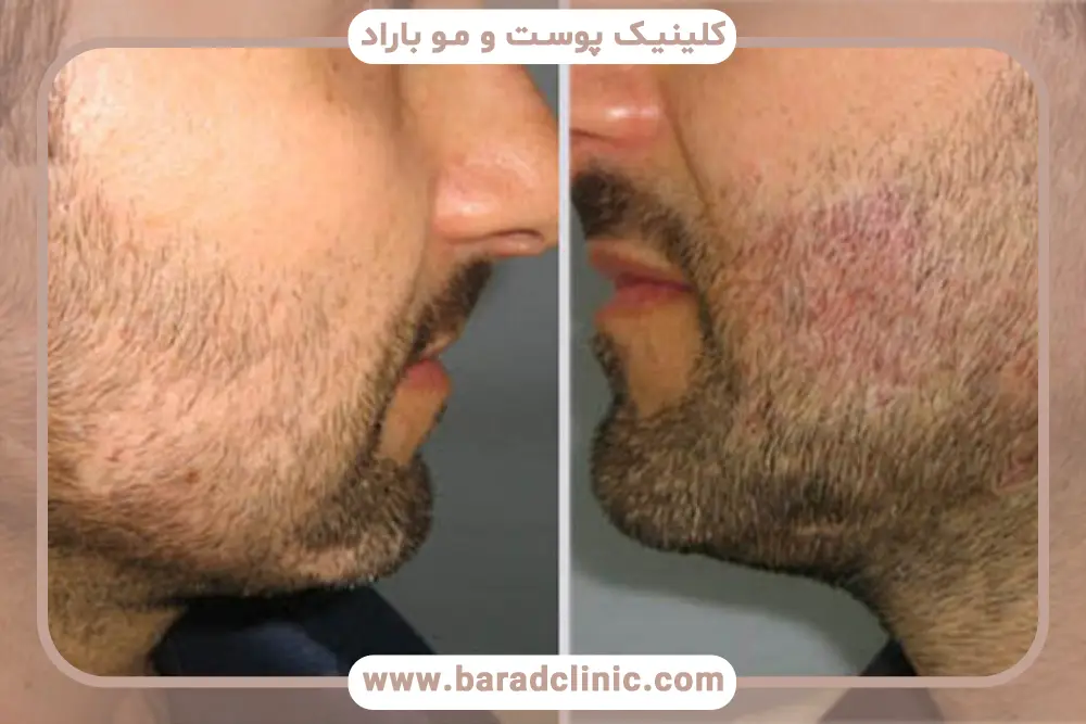 دلایل مراقبتهای بعد از کاشت روی کاشت ریش ناموفق