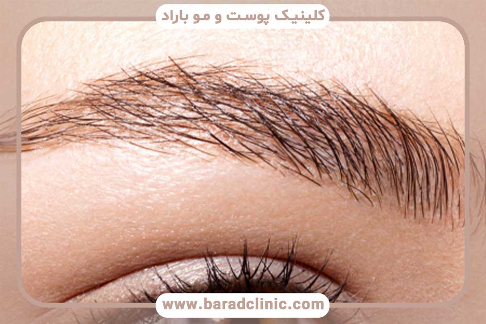 جای بخیه بعد از کاشت ابرو