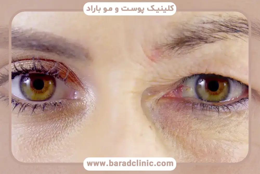 مزایای بلفاروپلاستی توسط چشم پزشک