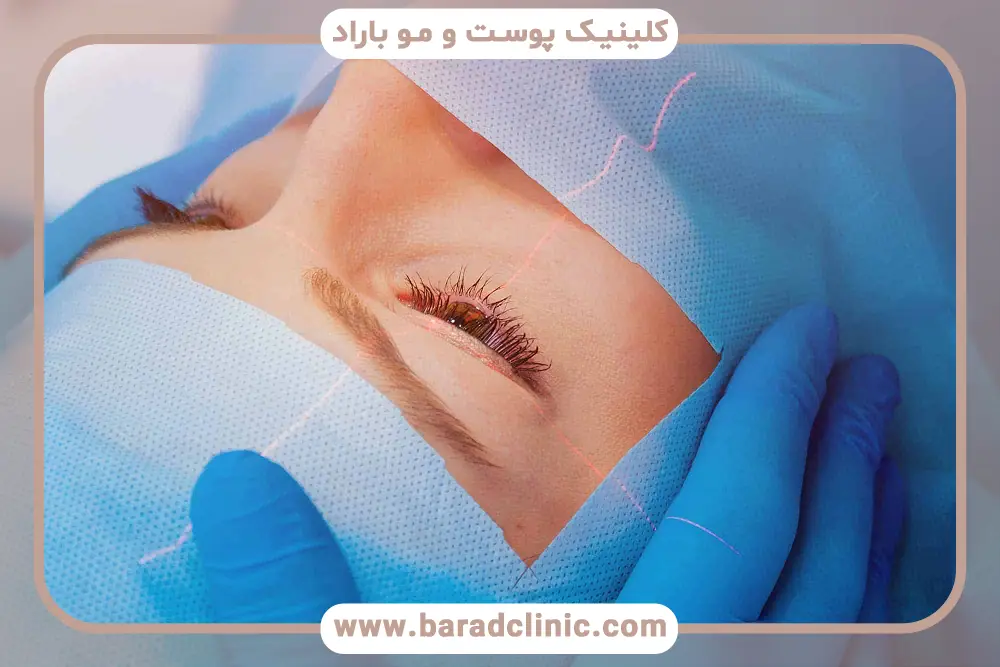 خطرات بلفاروپلاستی توسط پزشک عمومی