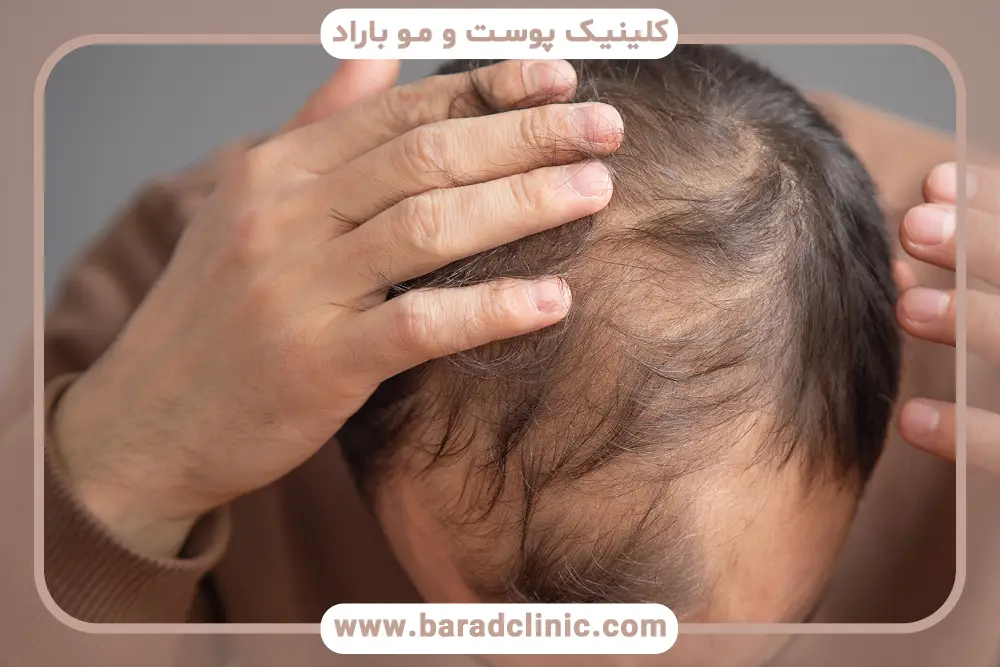 رژیم غذایی برای جلوگیری از ریزش مو تستوسترون